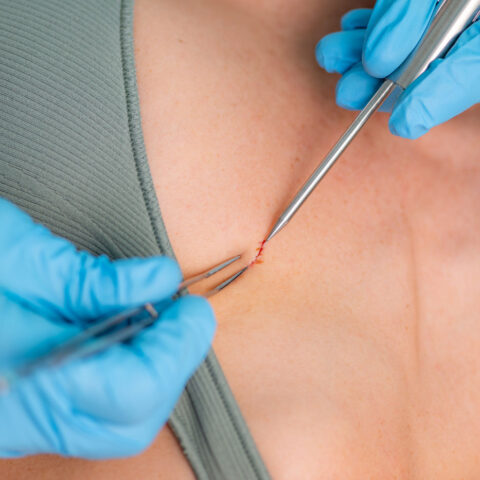 cilt-alti-implant-yerlestirme